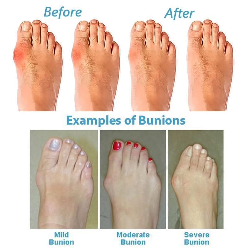 Damen-Sandalen mit Zehensteg gegen Hallux valgus