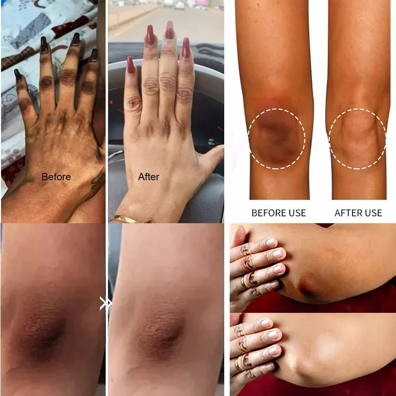 Snow Bleach: Natural Skin Tone Restoration for Bikini, Perianal, Vaginal, & Underarm Areas - Boost Confidence for Beach Outings & Intimate Moments.
