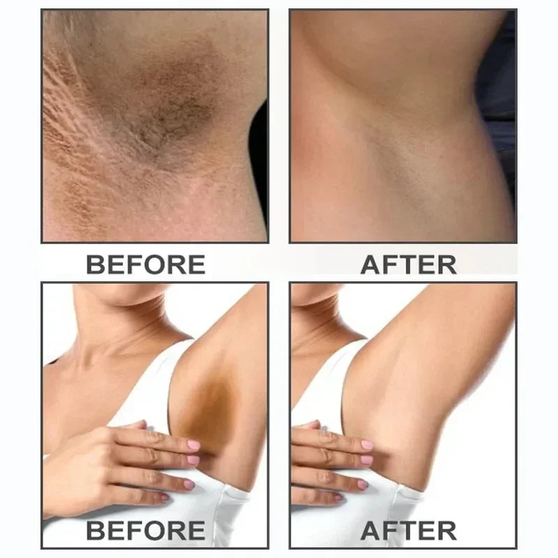 Snow Bleach: Natural Skin Tone Restoration for Bikini, Perianal, Vaginal, & Underarm Areas - Boost Confidence for Beach Outings & Intimate Moments.