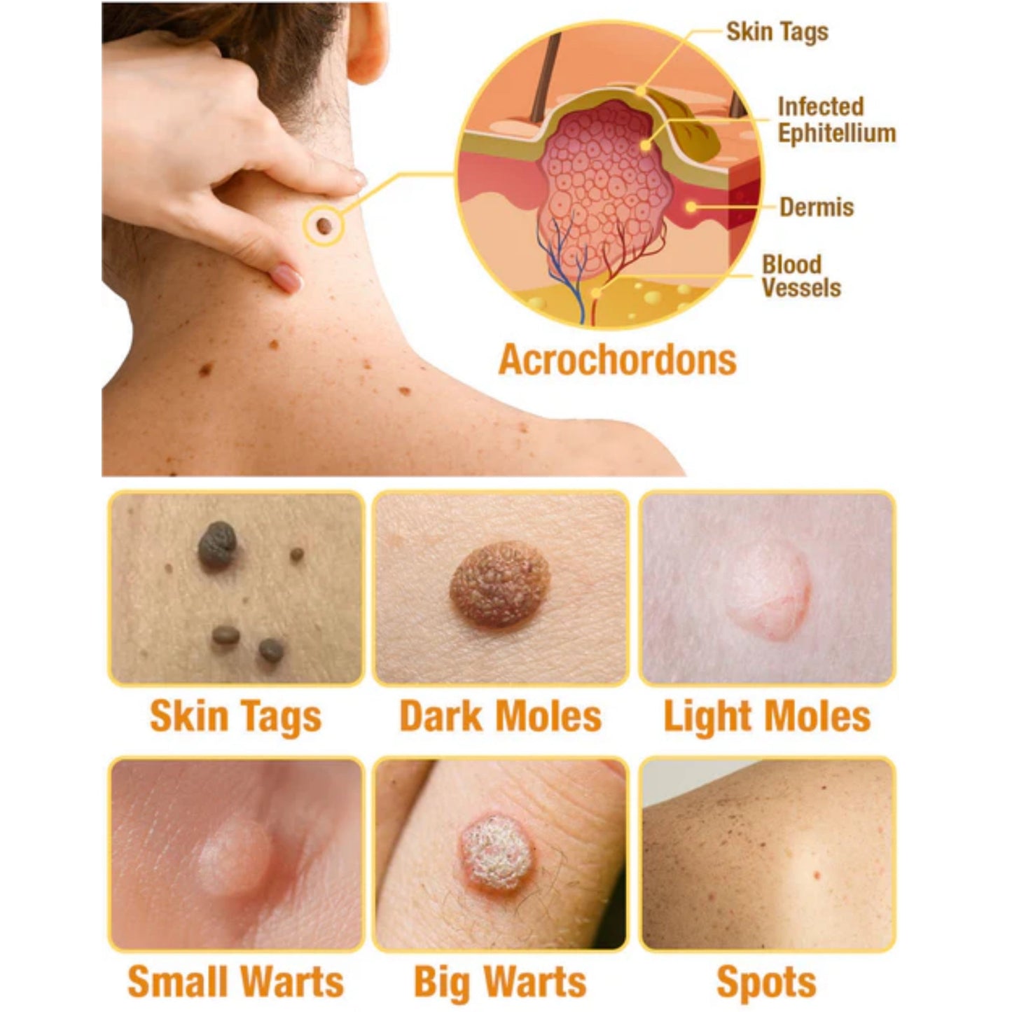 TagAway - Effective removal of warts and skin growths