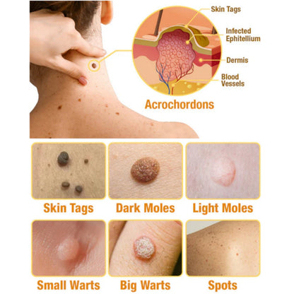 TagAway - Effective removal of warts and skin growths
