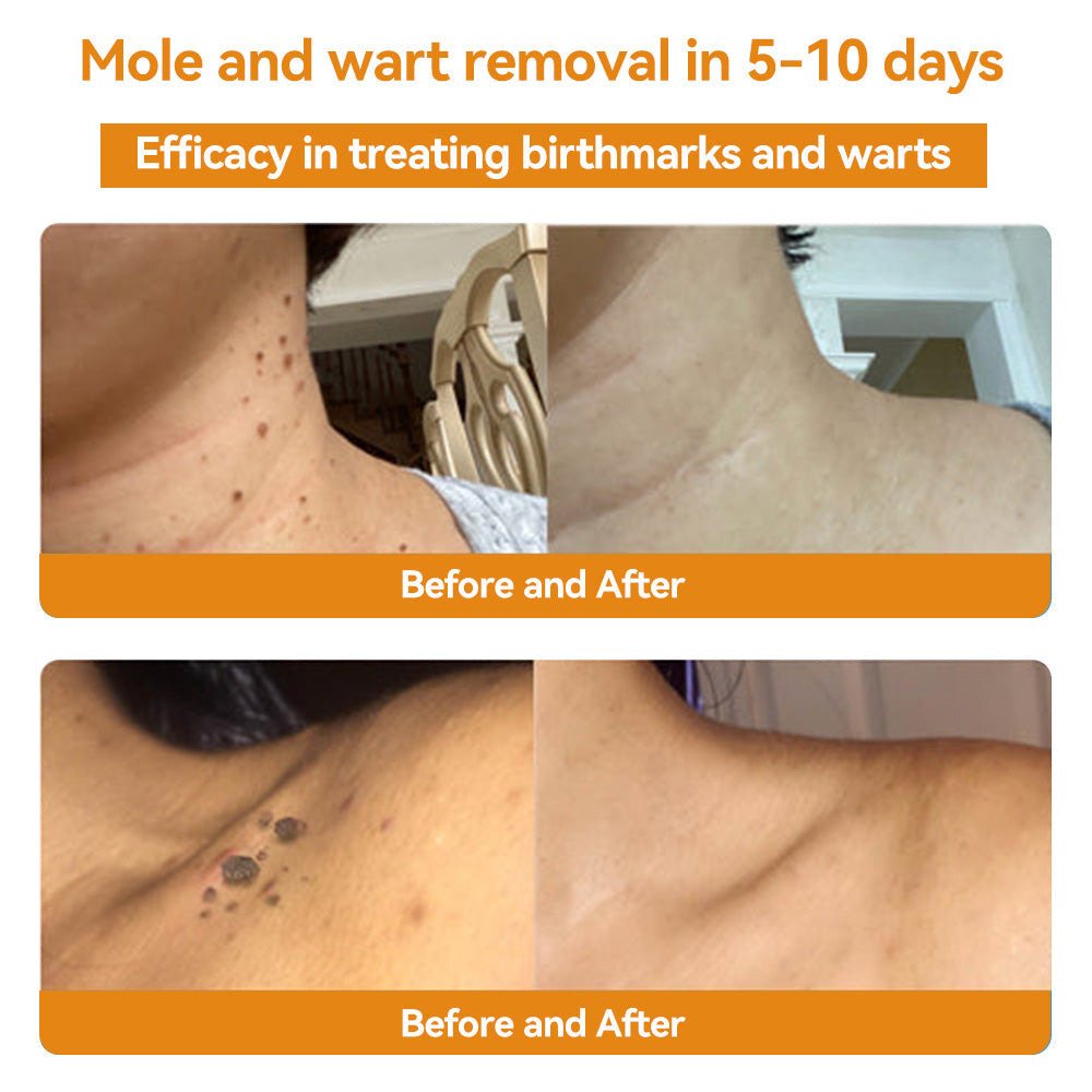 TagAway - Effective removal of warts and skin growths