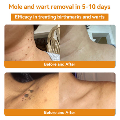 TagAway - Effective removal of warts and skin growths