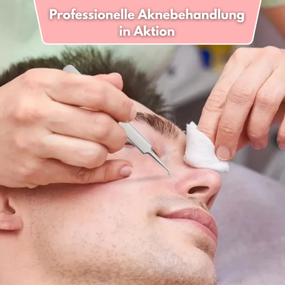ClearPore™ – Mitesser-Pinzetten-Entferner-Set, präzise, effektiv, sicher & hygienisch [1 + 1 Gratis]