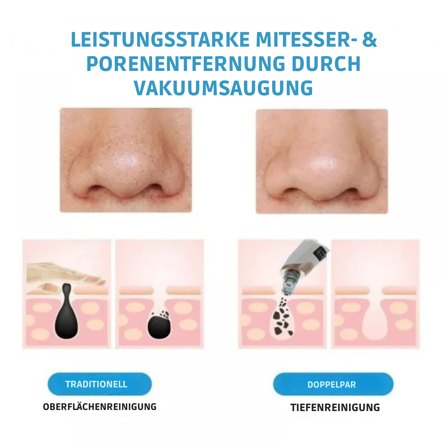 MitesserMeister™ / Elektrischer Mitesserentferner