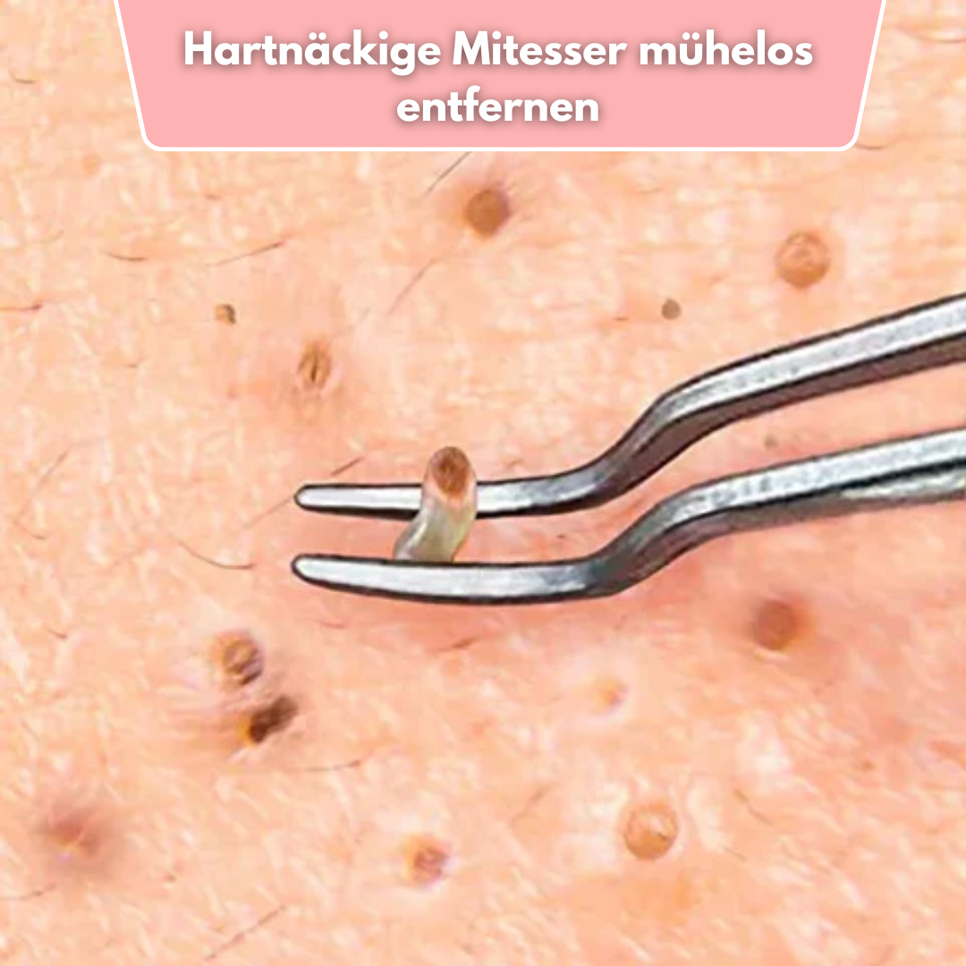 ClearPore™ – Mitesser-Pinzetten-Entferner-Set, präzise, effektiv, sicher & hygienisch [1 + 1 Gratis]