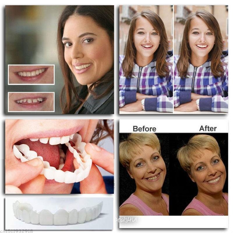 SnapSmile™ – Bequeme und sichere Zahnprothesen für ein strahlendes Lächeln [50% Rabatt]