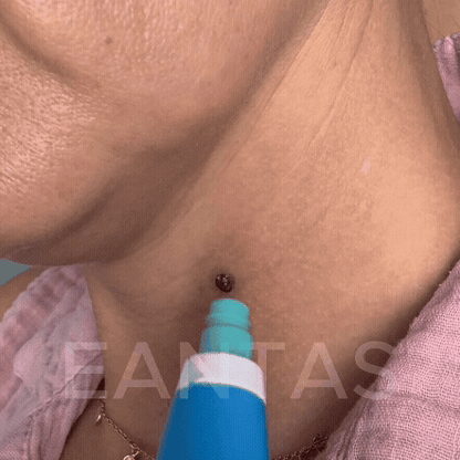 ALCURA™ | Glatte Haut in nur 4 Tagen