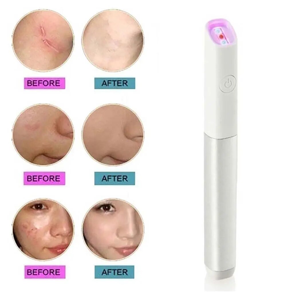 ReviveSkin: Anti-Varicose Veins Removal Pen