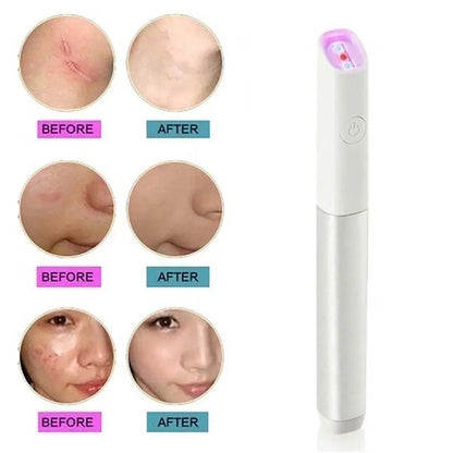ReviveSkin: Anti-Varicose Veins Removal Pen