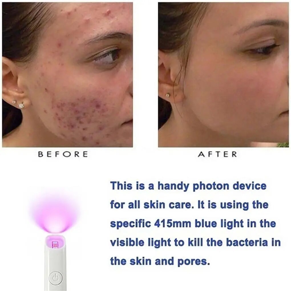 ReviveSkin: Anti-Varicose Veins Removal Pen