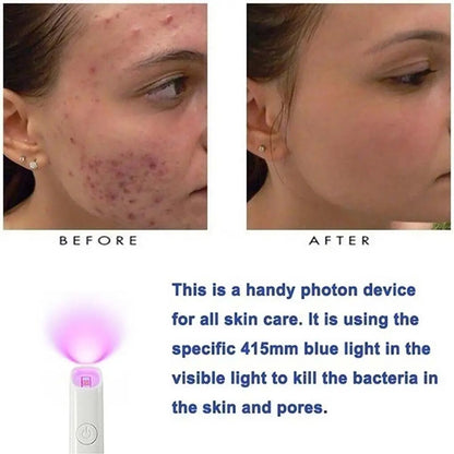 ReviveSkin: Anti-Varicose Veins Removal Pen