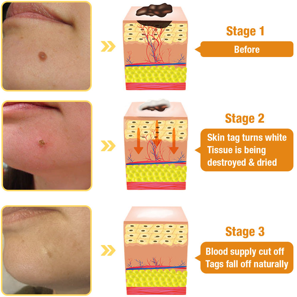 TagAway - Effective removal of warts and skin growths