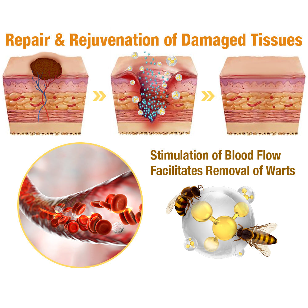 TagAway - Effective removal of warts and skin growths