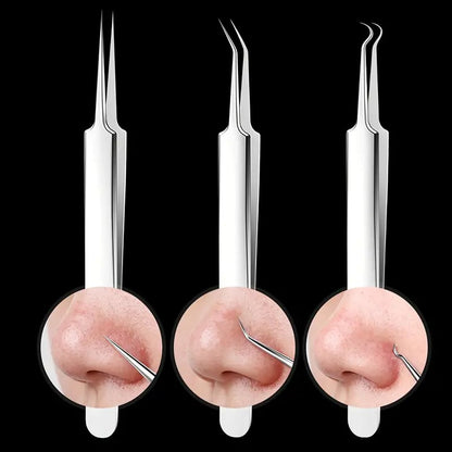 ClearPore™ – Mitesser-Pinzetten-Entferner-Set, präzise, effektiv, sicher & hygienisch [1 + 1 Gratis]
