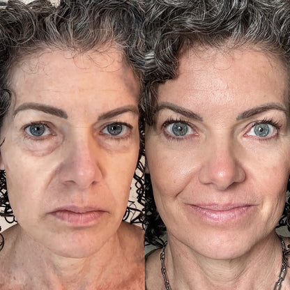 EyeRevive™ | Verabschieden Sie sich von Augenringen und Schwellungen!