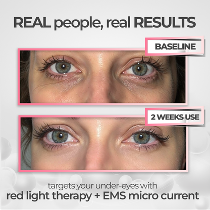 EyeRevive™ | Verabschieden Sie sich von Augenringen und Schwellungen!
