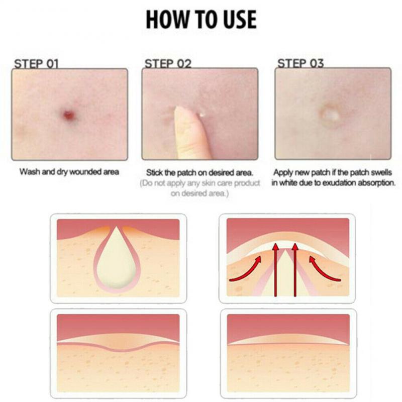 Acne Pimple Master Patch (36 Patches)