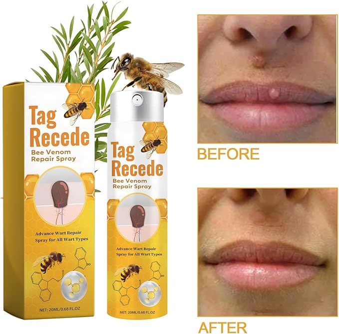 TagAway™ – Effektive Entfernung von Warzen und Hautwucherungen schnell und sicher [50% Rabatt]