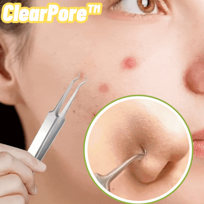 ClearPore™ – Mitesser-Pinzetten-Entferner-Set, präzise, effektiv, sicher & hygienisch [1 + 1 Gratis]